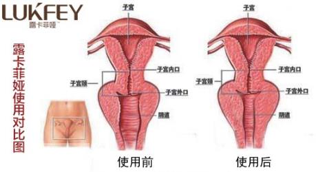 女人縮陰用什么藥最好,五步告訴你最好的產品!