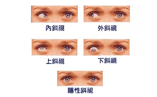 兒童斜視是什么 如何預防兒童斜視