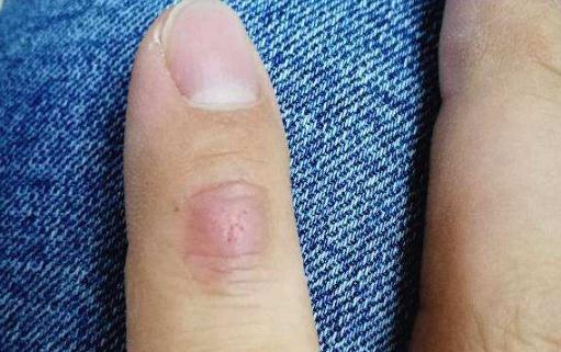 手指關節鼓個硬疙瘩圖片 手指關節鼓個硬疙瘩怎么治