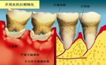 牙周炎會誘發類風濕關節炎