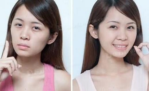 自體脂肪墊下巴術后如何護理?