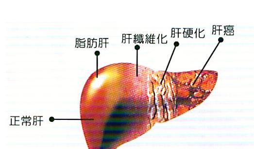 脂肪肝的治療方法 應酬男應該看看