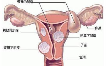 【子宮】子宮保健_子宮肌瘤,子宮內(nèi)膜炎等子宮疾病預(yù)防和治療知識 【子宮】子宮保健_子宮肌瘤,子宮內(nèi)膜炎等子宮疾病預(yù)防和治療知識