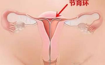 【節育環】節育環何時取出_帶哪種節育環好_取避孕環需要多少錢_上節育環后吃什么 【節育環】節育環何時取出_帶哪種節育環好_取避孕環需要多少錢_上節育環后吃什么