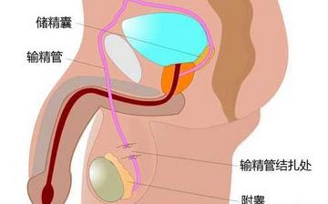 【男性結(jié)扎】男性結(jié)扎手術(shù)_結(jié)扎手術(shù)對男性的影響_男性結(jié)扎注意什么
