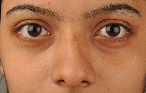 黑眼圈不僅是因為腎虛 黑眼圈透露你身體的健康問題