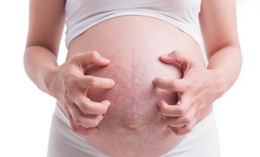 妊娠紋是怎么產生的？該如何改善呢？