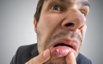 口腔潰瘍的認識誤區 能緩解口腔潰瘍的水果