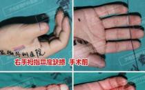濟(jì)南顯微外科醫(yī)院 黃威手指再造怎么樣 有真實(shí)的手術(shù)案例嗎