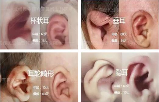 新生兒耳廓畸形能矯正嗎？看成都民生耳鼻喉醫(yī)院如何支招