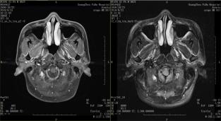 江蘇腫瘤醫院認準廣州復大腫瘤醫院：警惕鼻咽癌