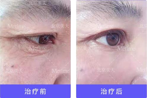 熱瑪吉抗衰(Thermage)官方認證中國指定操作醫生—北京美天張潘院長