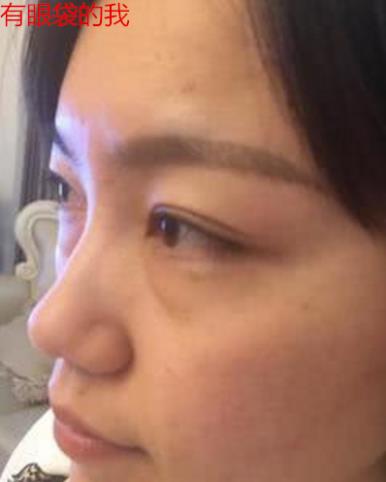 衛(wèi)婭日記：我一直都以為眼袋對(duì)我的影響只是美觀，直到我了解了以后……
