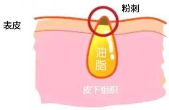 甲硝唑凝膠去黑頭要看主流，別拿個(gè)體差異混淆視聽