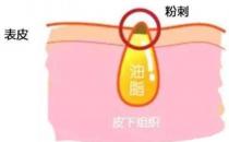 甲硝唑凝膠去黑頭要看主流，別拿個體差異混淆視聽