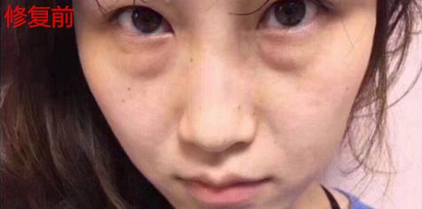 君雅筆記：眼袋過重，就會(huì)顯得比真實(shí)年齡大，要如何修復(fù)眼袋呢？