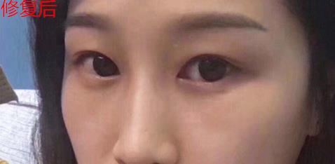 幻柔筆記：眼袋修復后氣質立現，怎么看都是青春靚麗！