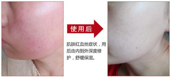 放心！有美薏升修復敏感肌紅血絲專家產品在，你每天都可以美美噠