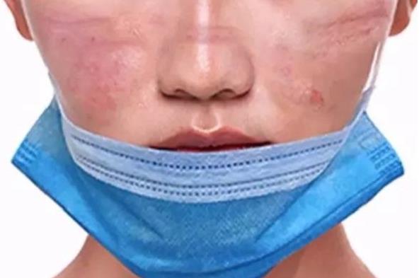 長期戴口罩痘痘叢生？有甲硝唑凝膠祛痘不用慌